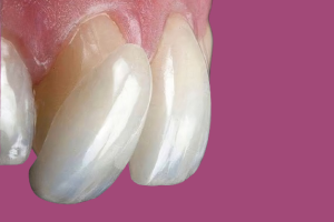 Dental_veneers_and_laminate_LE_auto_x2-removebg-preview